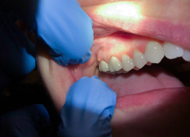Best Emergency Dentist for Knocked-Out Tooth in Conneaut Lakeshore, PA