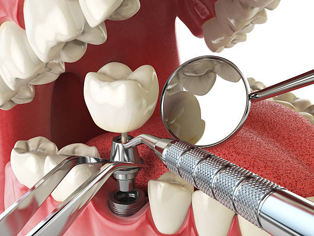 Best Emergency Dentist for Lost Fillings or Crowns in Conneaut Lakeshore, PA